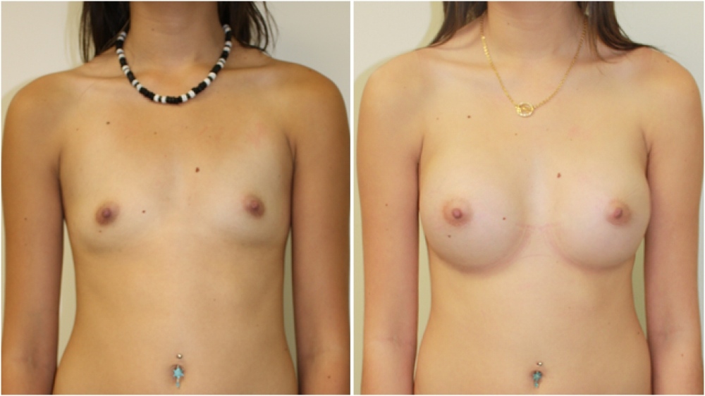 19yo, no children, 335g round high profile textured implants, dual plane 2 placement, A -> C cup.