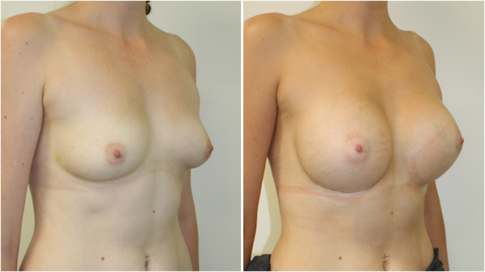 Mid 20s, no children, 380cc round high profile textured implants, dual plane placement, B- > DD cup.