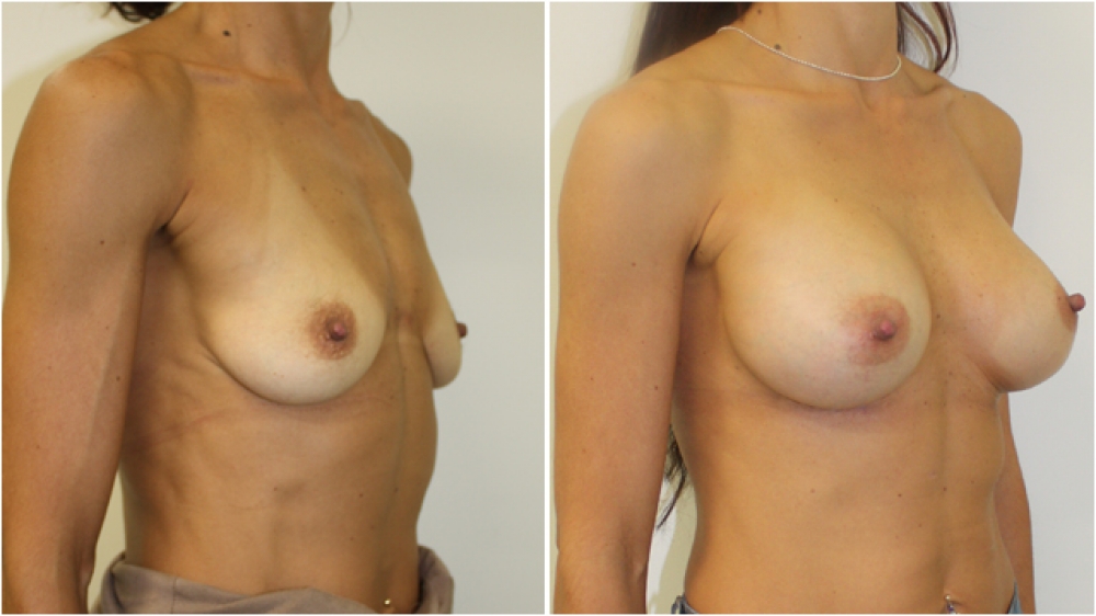 Mid 40s, athletic patient, three children, 325g anatomical (teardrop) high profile implants, dual plane 3 placement, small B -> full C cup.