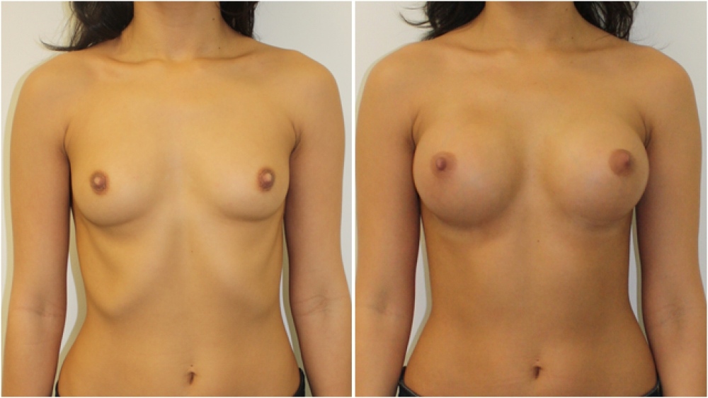 21 years old, no children, 215cc round high profile implants, dual plane 2 placement. B- > full C cup.