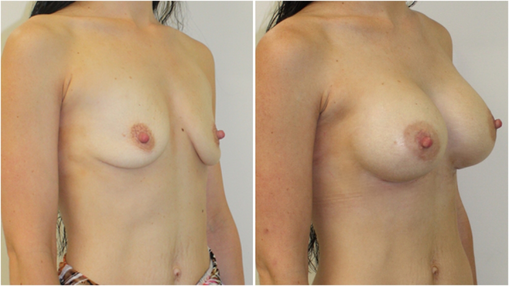 30 yo, 3 children, 360g extra full projection implants, dual plane 3 placement. A cup > D cup.