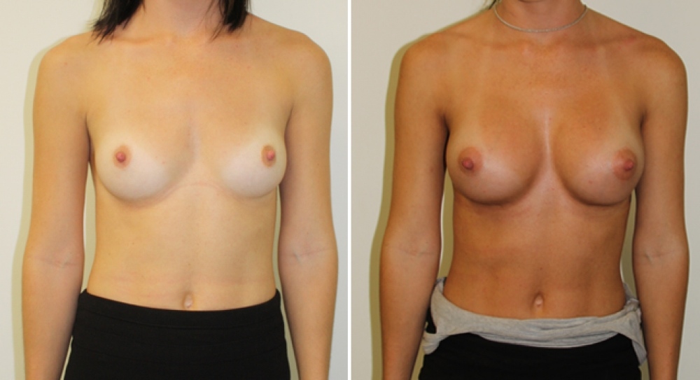 Mid 20s, no children, 315g moderate profile anatomic (teardrop) shaped, P-URE (polyurethane coated) implants, dual plane 2 placement. B -> D cup.