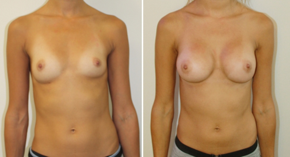 29 years old, no children, 225g high profile anatomic (teardrop) implants, dual plane 1 placement.