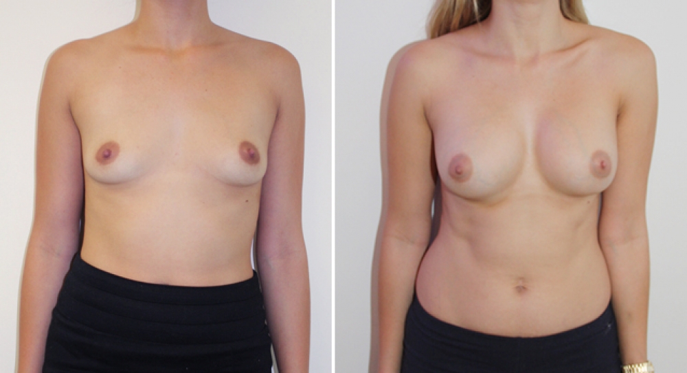 Early 20s, 1 child, dual plane 2 placement, 360g anatomical (teardrop) moderate projection implants.