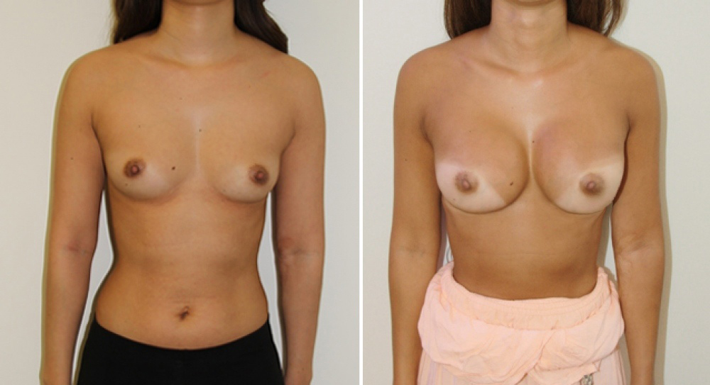 Late 20's, no children, breast augmentation procedure performed using 360g anatomical (teardrop) implants, dual plane 1 placement.