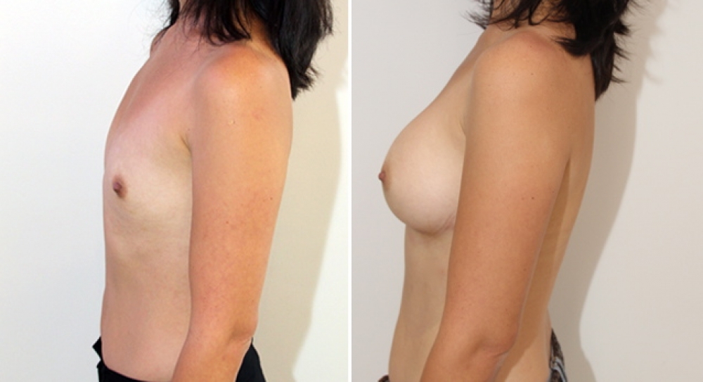 Late 30s, 3 children, breast augmentation performed using 350g anatomical (teardrop) implants with dual plane 3 placement.