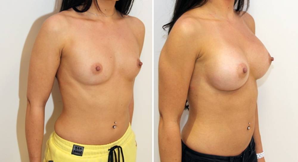 Mid 20s, no children, breast augmentation performed using 345g round implants with dual plane 2 placement.