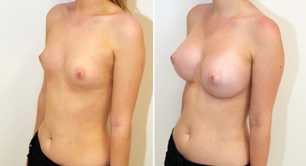 Early 20's, no children, bilateral breast augmentation performed using 390g, round implants, with dual plane 3 placement.