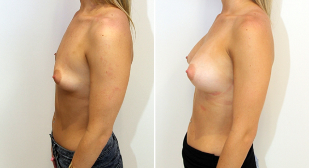 20yo, no children, breast augmentation performed using 360g anatomical (teardrop) implants with dual plane 2 placement.