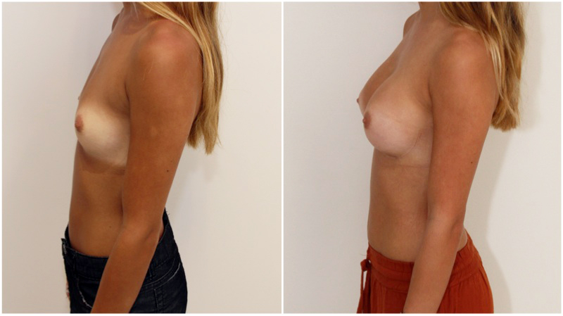 20s, dual plane, 245g anatomical.