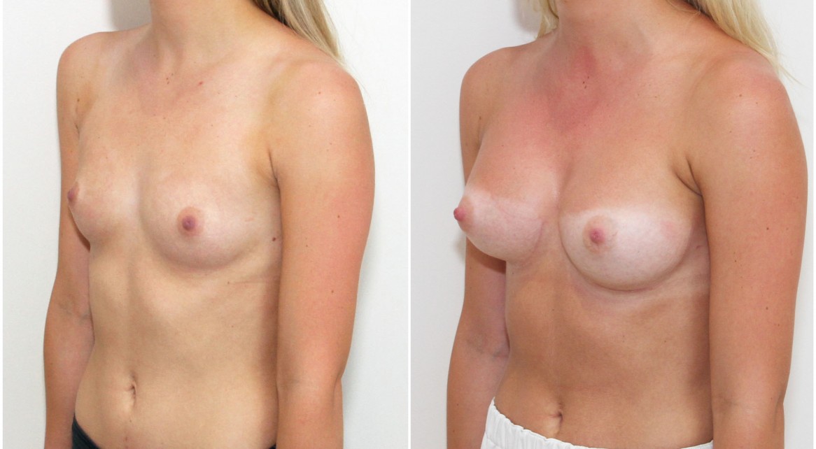 Early 20s, 255g moderate plus profile anatomical (teardrop) memory gel style, dual-plane 2.