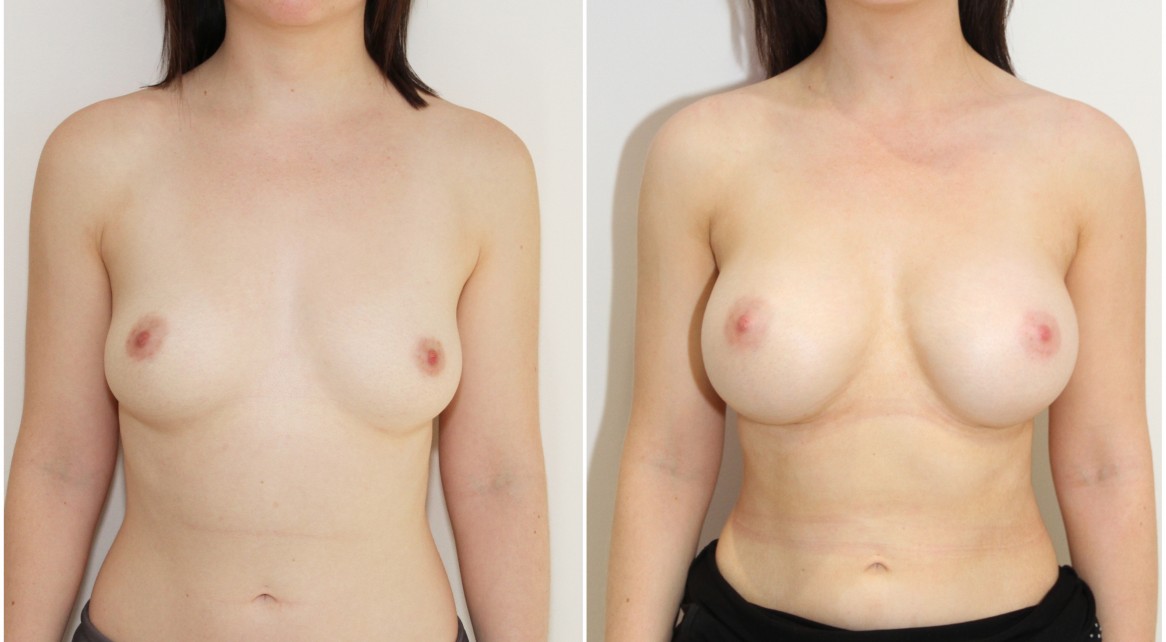 20s, no children, 275g moderate profile, round style implants, submuscular placement.