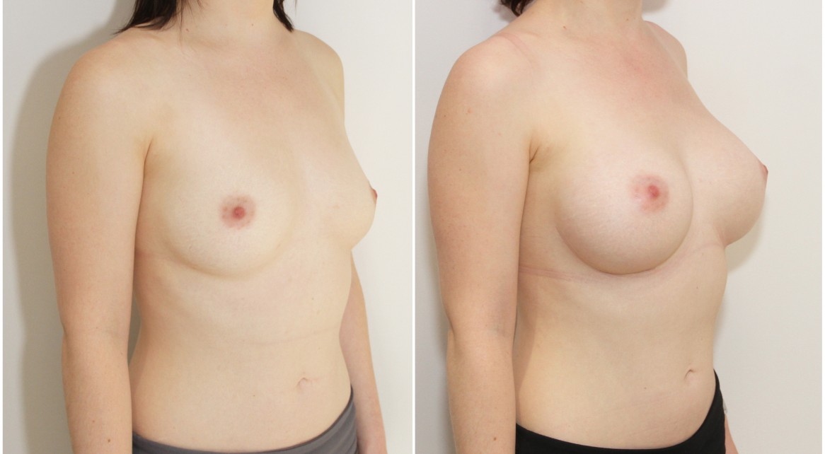 20s, no children, 275g moderate profile, round style implants, submuscular placement.