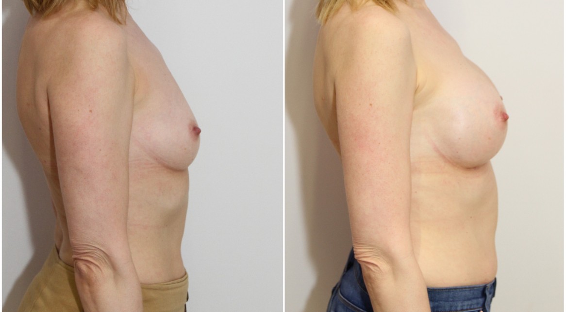 40s, 300cc round style, moderate plus profile, subfascial placement.