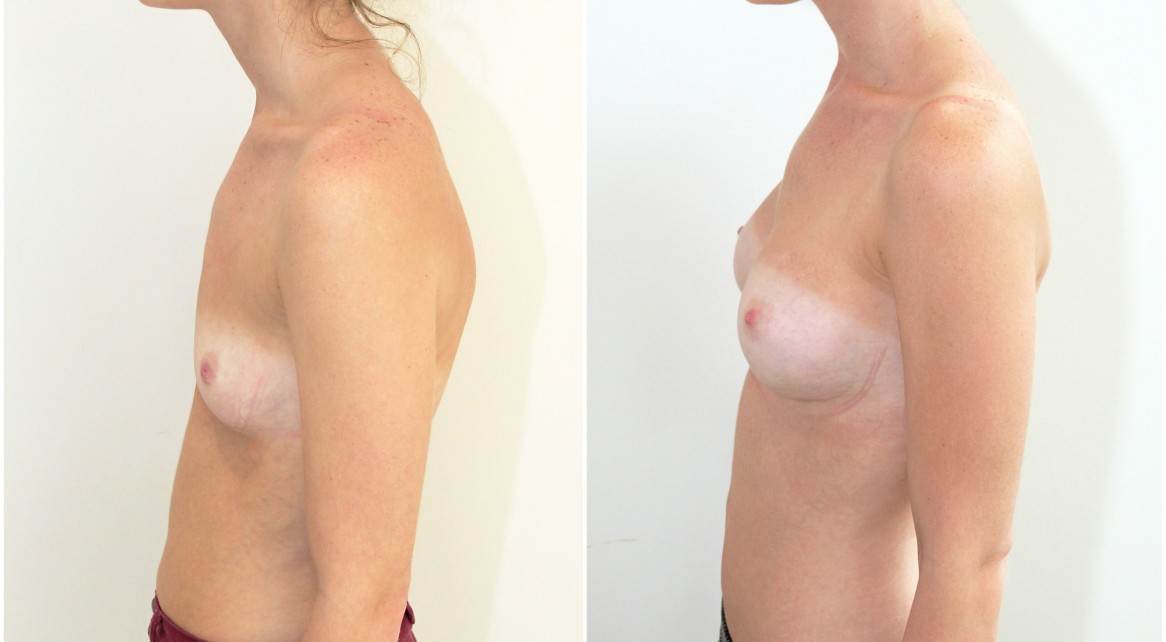 20s, 315g, moderate profile, anatomical (teardrop), dual plane 1 submuscular placement.