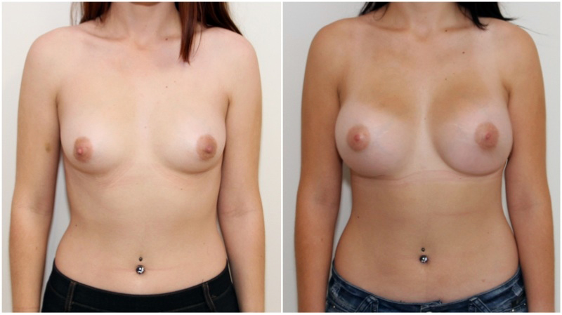 20s, 330g moderate plus profile, subfascial placement.