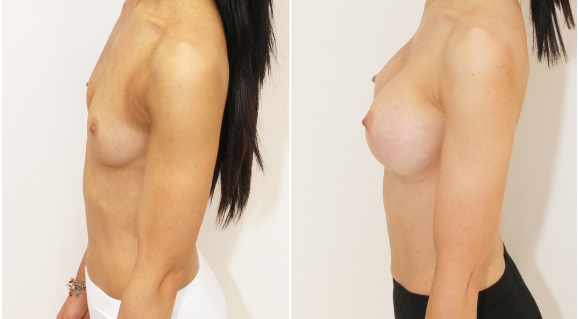 20s, 330cc CPG dual plane 2, anatomics.