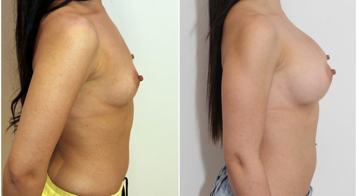 25yo, 345g, round, full projection, submuscular positioning.