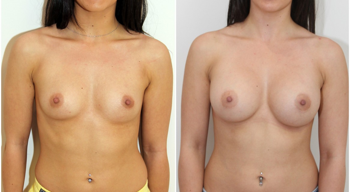 25yo, 345g, round, full projection, submuscular positioning.