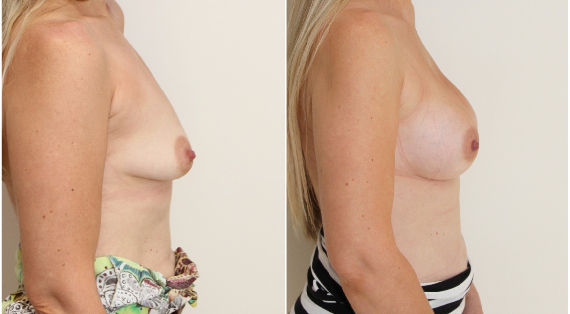 Droop correction with subfascially positioned 345g high profile anatomical implants.