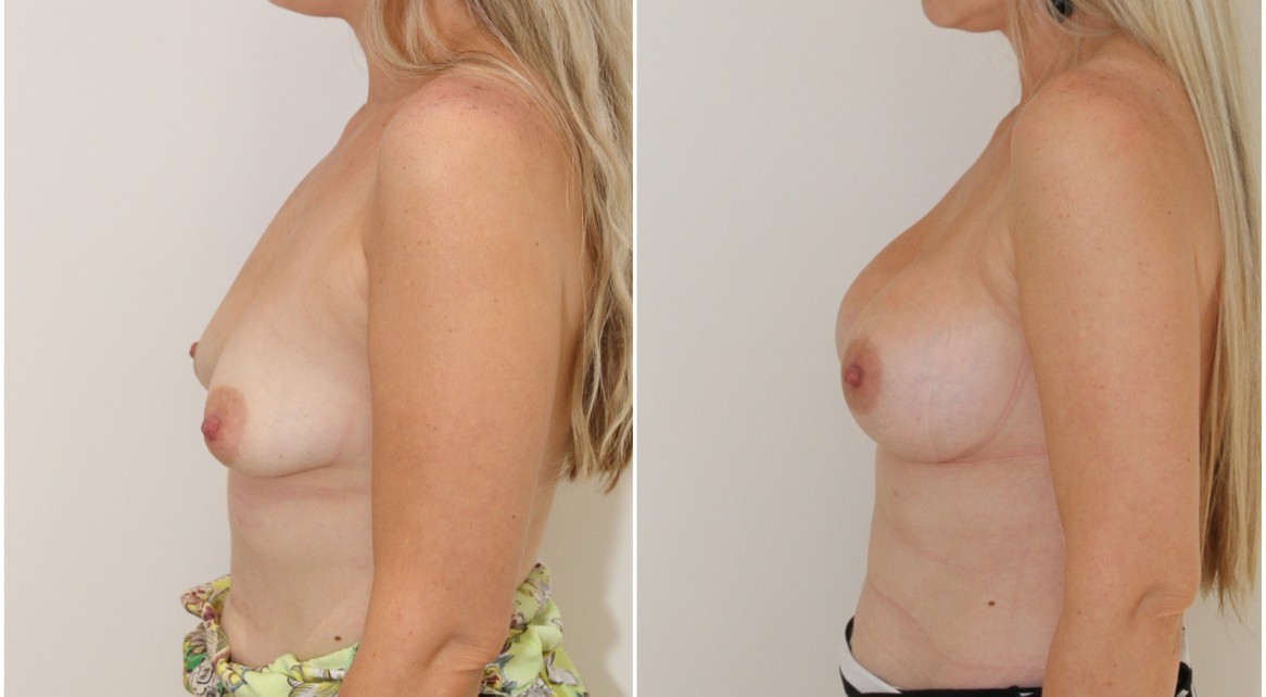 Droop correction with subfascially positioned 345g high profile anatomical implants.