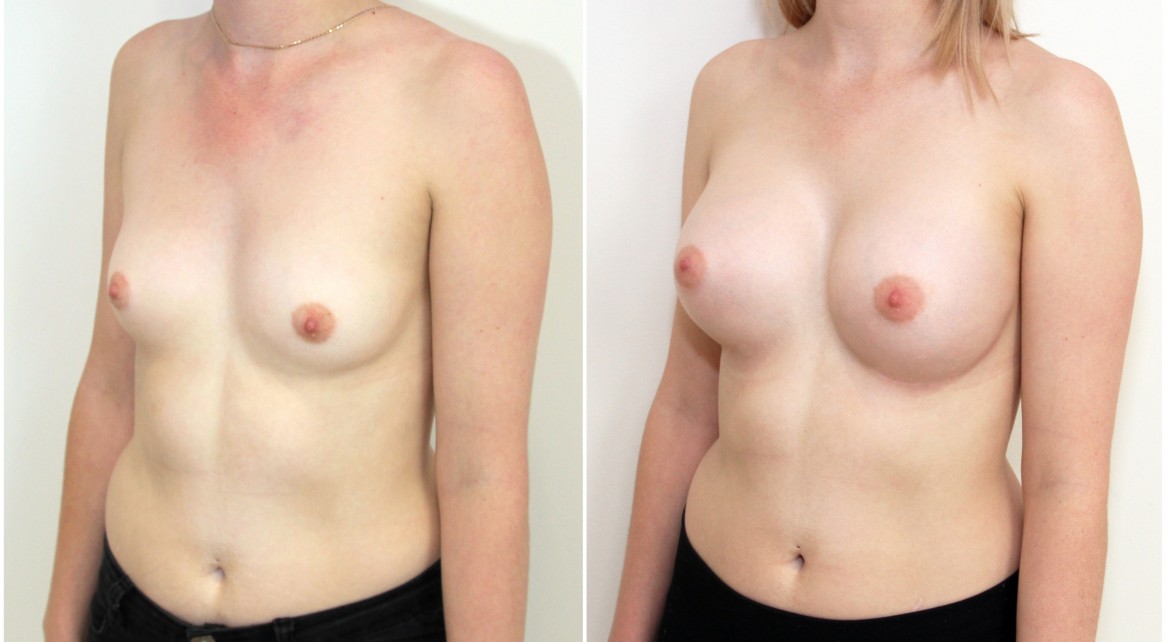 20s, 360g, moderate profile, dual plane 2, anatomics.