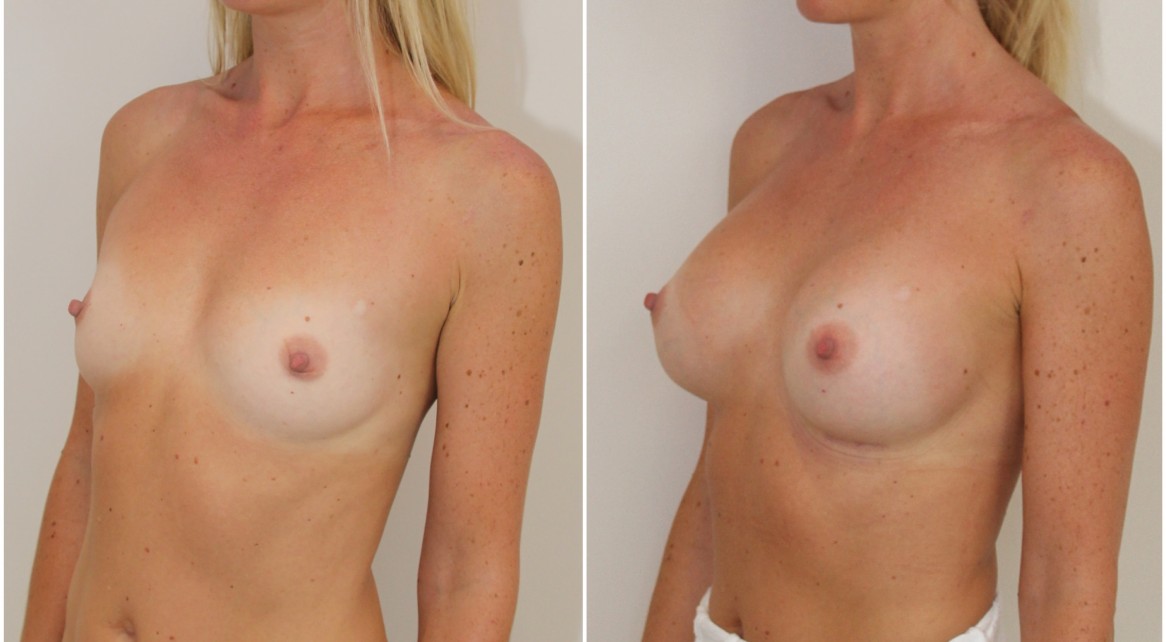 30s, 360g anatomical, moderate profile, submuscular placement.