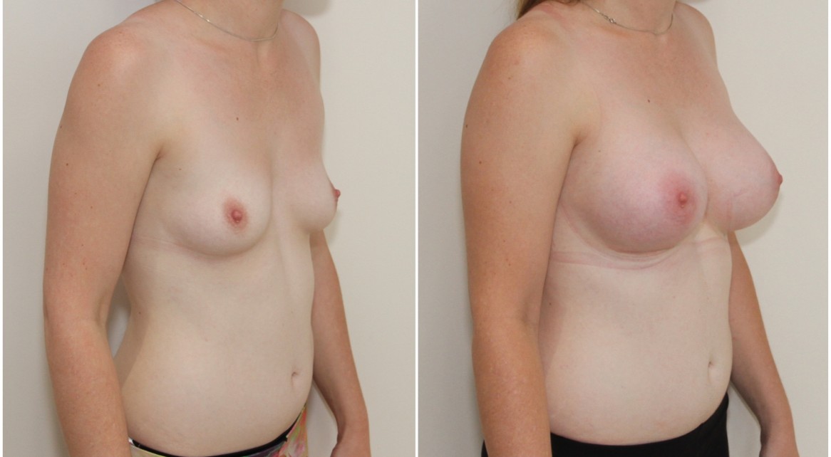 30s, 360g anatomical, moderate profile, submuscular placement.