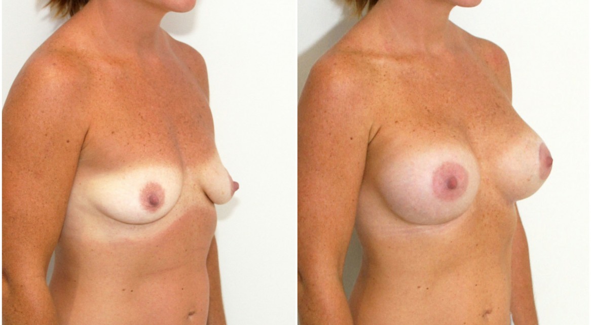 30s, 440cc high profile, anatomical, dual plane 3 positioned, peri-areolar crescent lift on the left breast to correct symmetry.