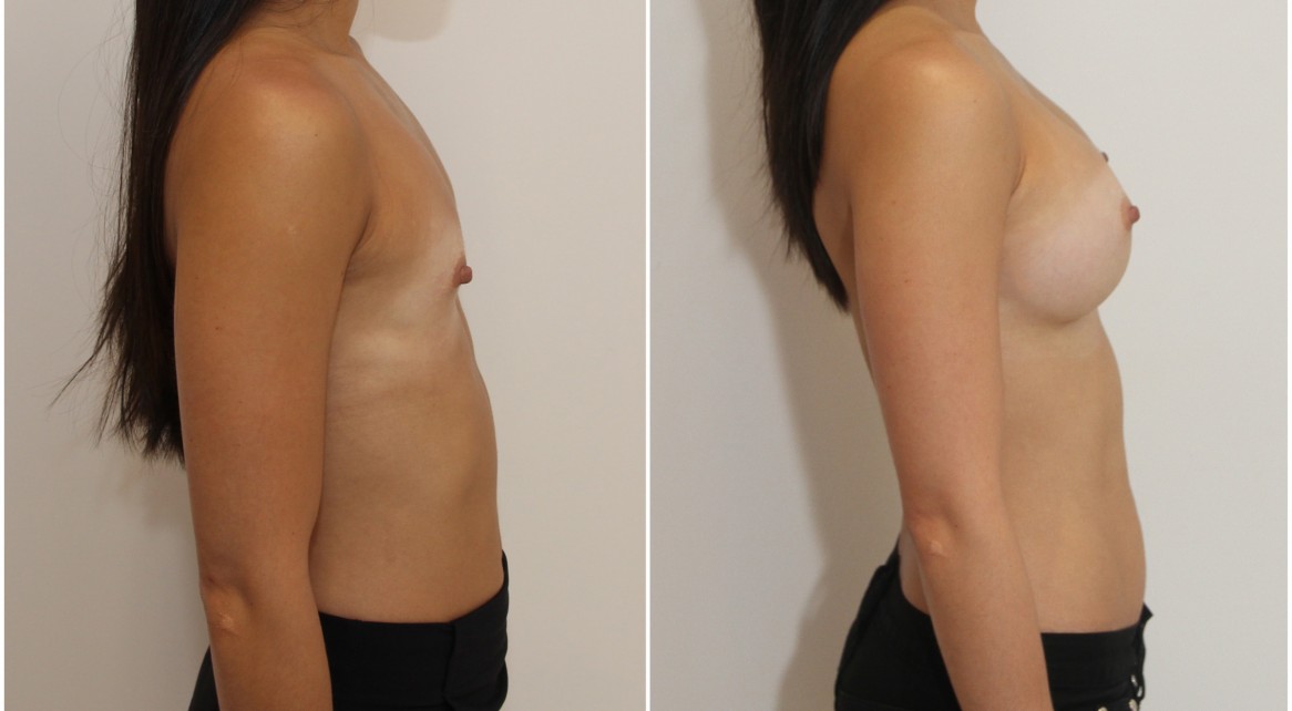 20s, dual plane 1, submuscular, 305g extra high profile, anatomical P-URE style, implants.