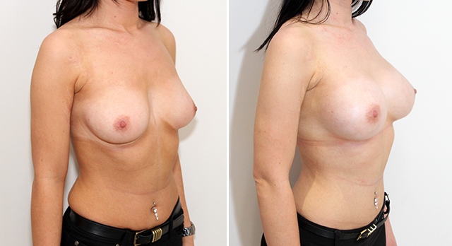 30yo, 375cc, anatomical, dual-plane 2 positioned.