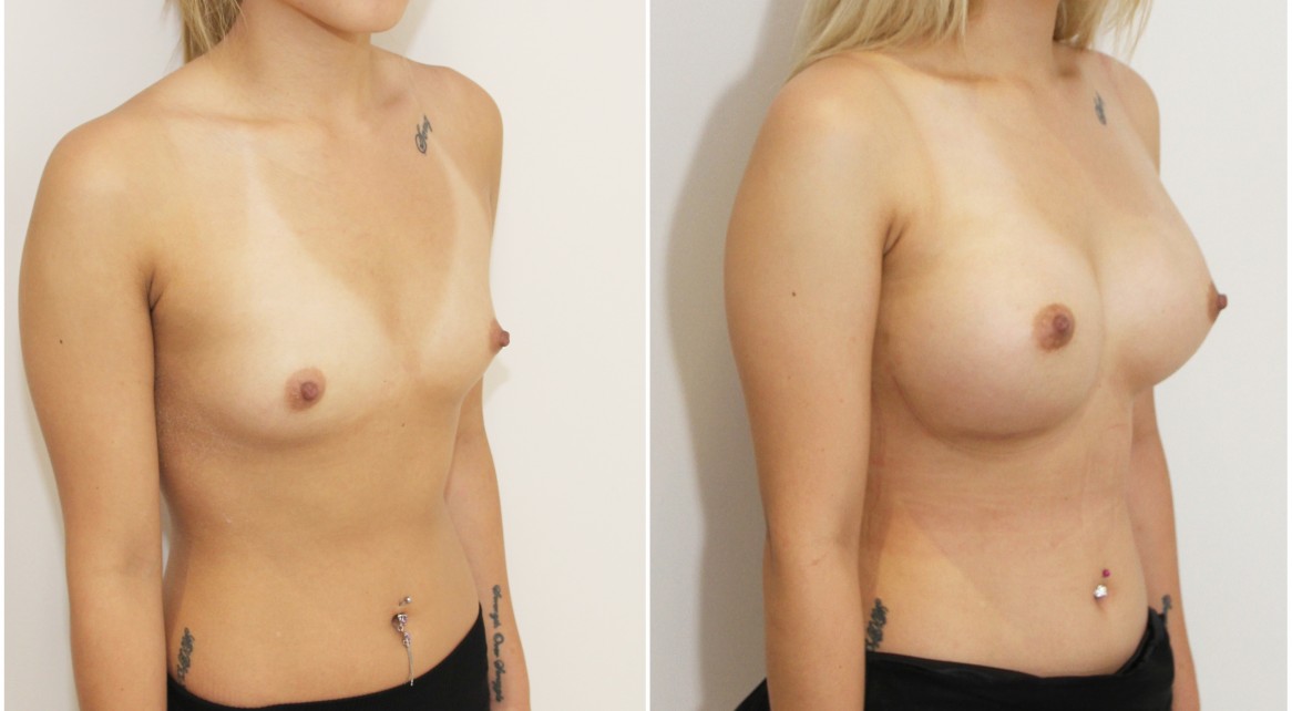 20s, breast augmentation with high profile, round style, dual plane positioned implants.