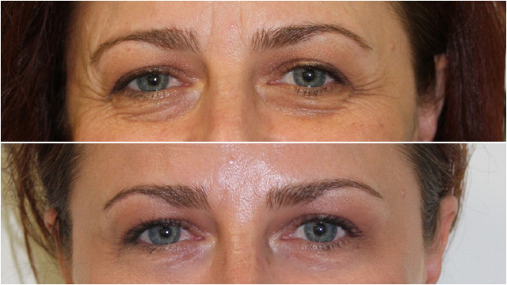Dramatic eye rejuvenation achieved with a combination of injectable hyalauronic acid filler and anti-wrinkle injections. This 30 minute in-room treatment can take many years off a person's appearance.