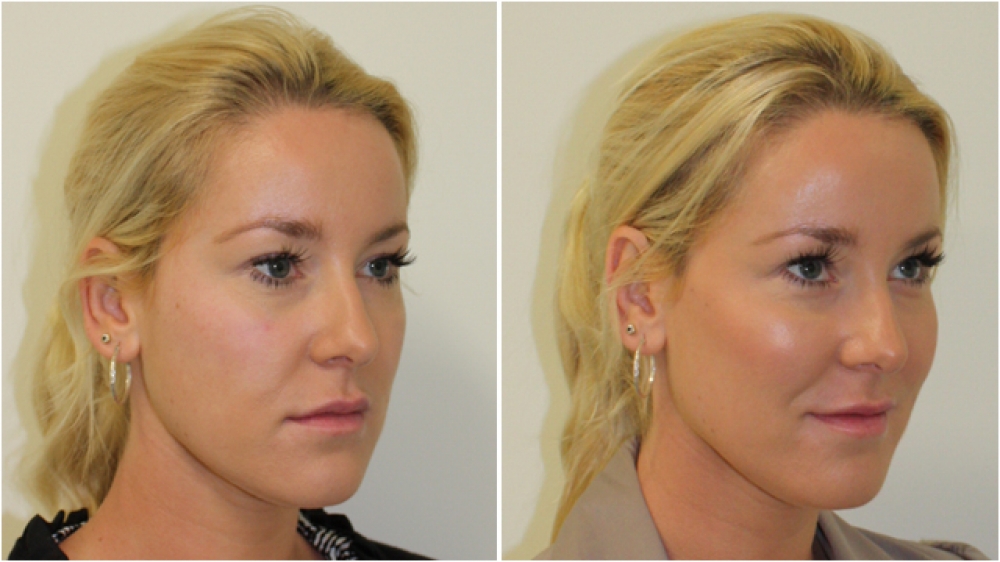 Mid-face enhancement using volumising dermal fillers
