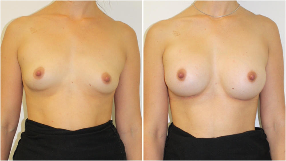 Subtle-style breast augmentation by Dr Miroshnik using 235g anatomics, moderate profile, dual-plane positioned