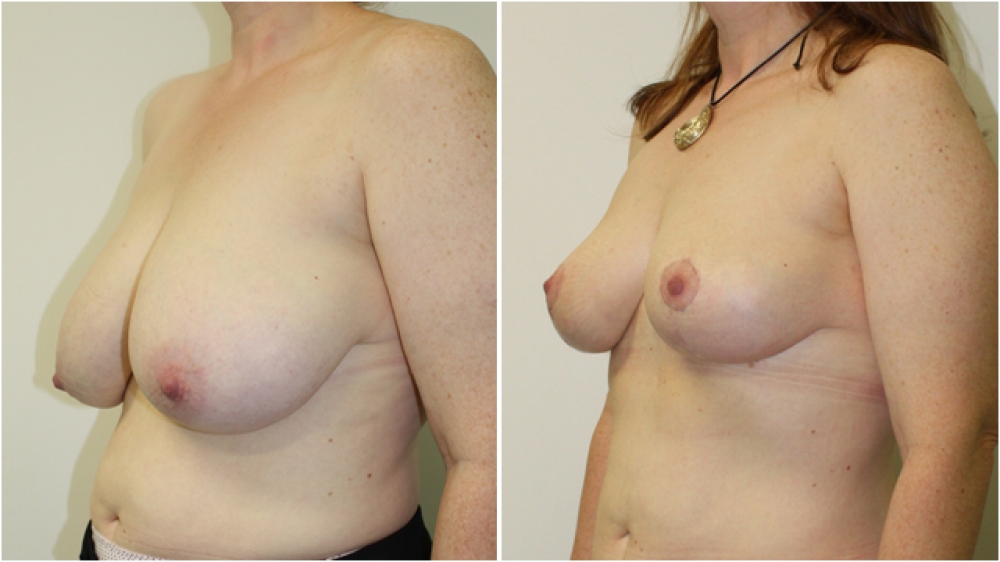 Late 40s, no children, vertical short incision breast lift (mastopexy) with nipple/areolar resizing and repositioning.