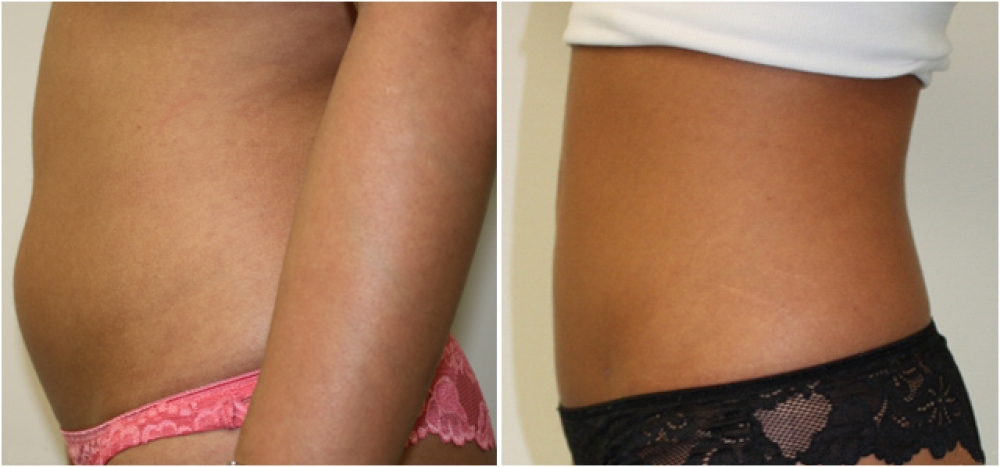 27 yo female, underwent liposuction to the tummy and flank area to give a more slender appearance.