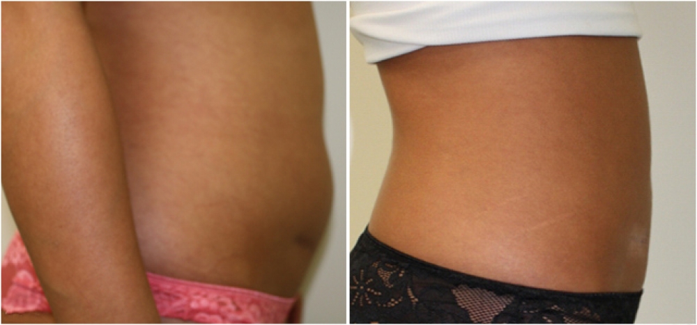 27 yo female, underwent liposuction to the tummy and flank area to give a more slender appearance.