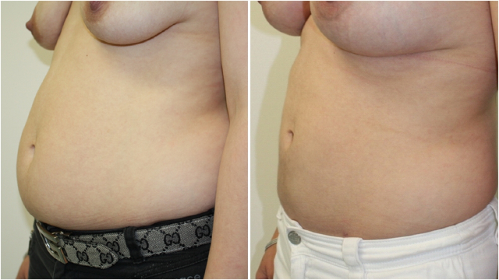 29yo female, liposuction to tummy and flanks.