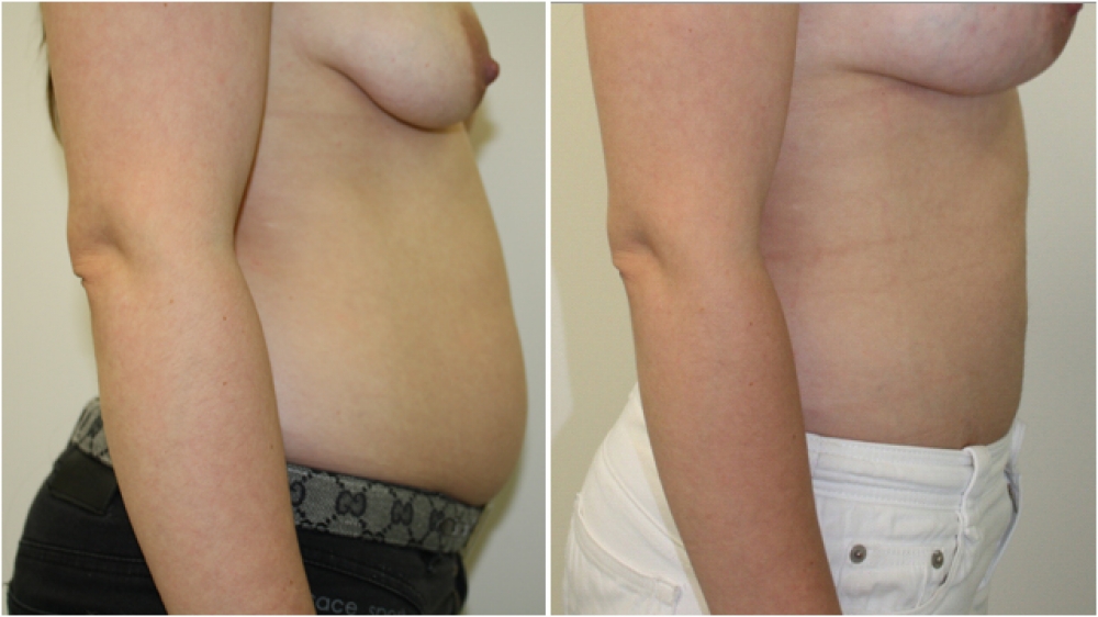 29yo female, liposuction to tummy and flanks.