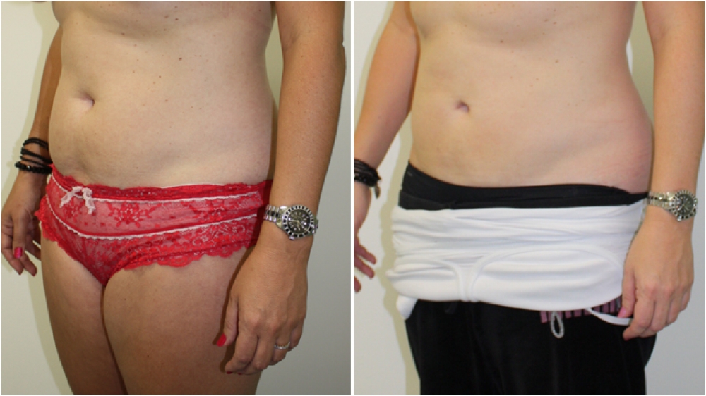 38yo female, liposuction to abdominal region.