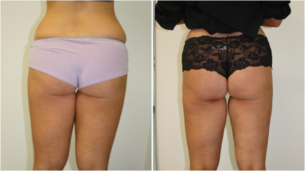 20s, female, liposuction to buttocks, thighs, flanks and tummy.