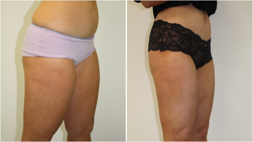 20s, female, liposuction to buttocks, thighs, flanks and tummy.