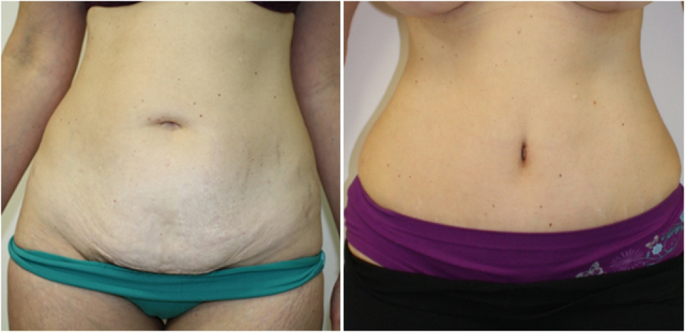 39 year old woman. 3 children. A full abdominoplasty was performed to provide a flat tummy and remove stretch marks, giving a much more streamlined appearance. A new, more attractive belly button was also created.