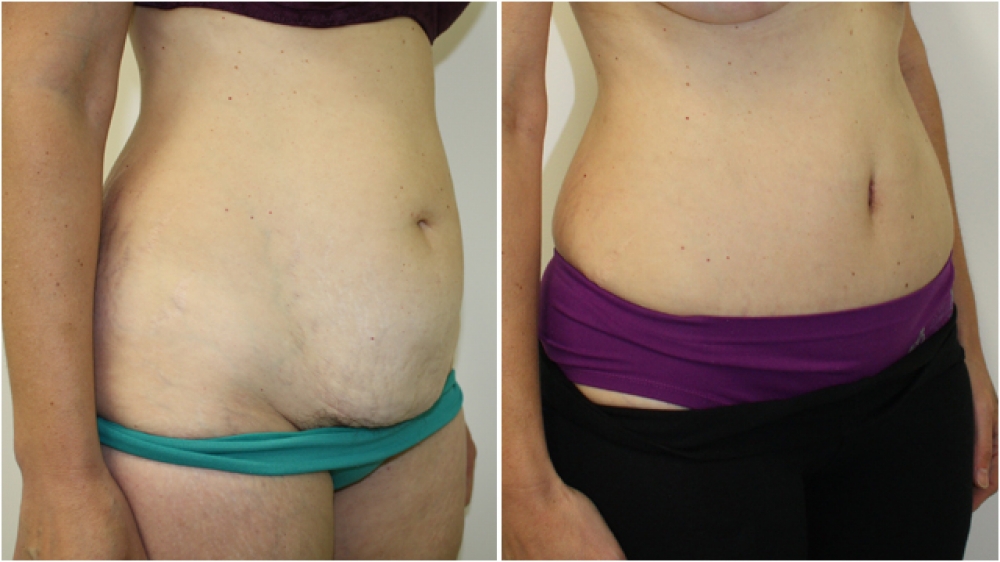 39 year old woman. 3 children. A full abdominoplasty was performed to provide a flat tummy and remove stretch marks, giving a much more streamlined appearance. A new, more attractive belly button was also created.