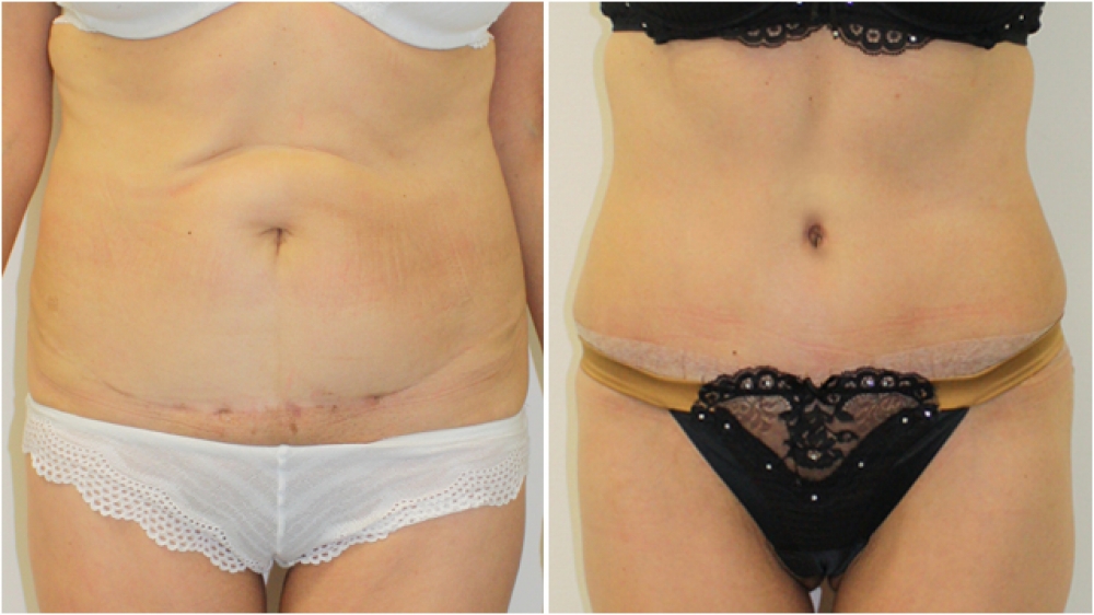 63yo female, requiring major contour restoration, belly button reshaping, as well as large amount of redundant skin and fat removal. An extended tummy tuck operation was performed to acMid 50s, excessive loose skin and previous scars from multiple abdomin