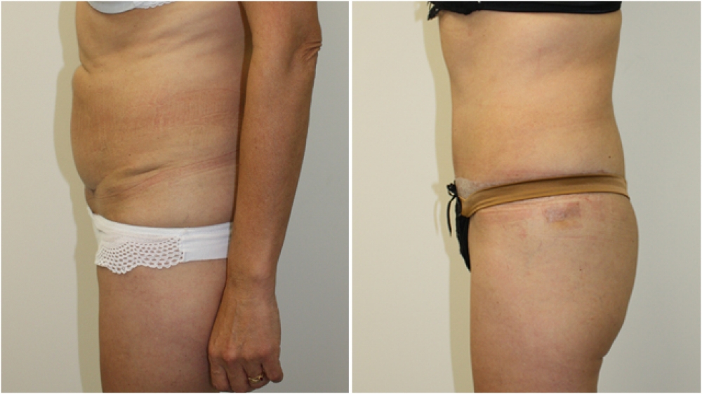 63yo female, requiring major contour restoration, belly button reshaping, as well as large amount of redundant skin and fat removal. An extended tummy tuck operation was performed to acMid 50s, excessive loose skin and previous scars from multiple abdomin