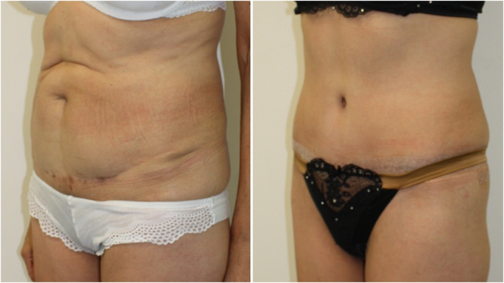 63yo female, requiring major contour restoration, belly button reshaping, as well as large amount of redundant skin and fat removal. An extended tummy tuck operation was performed to acMid 50s, excessive loose skin and previous scars from multiple abdomin