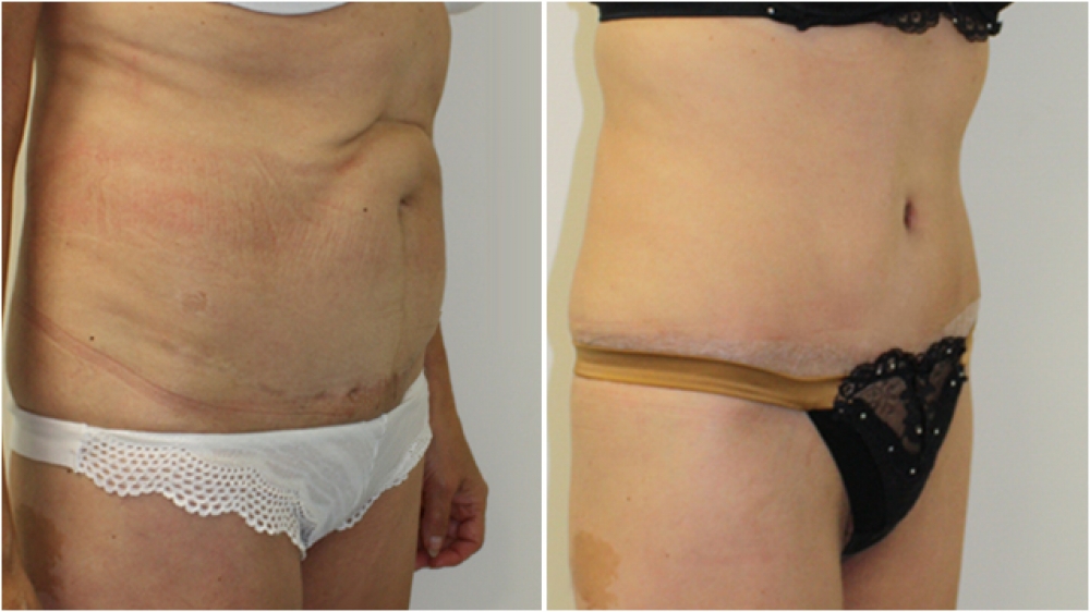63yo female, requiring major contour restoration, belly button reshaping, as well as large amount of redundant skin and fat removal. An extended tummy tuck operation was performed to acMid 50s, excessive loose skin and previous scars from multiple abdomin