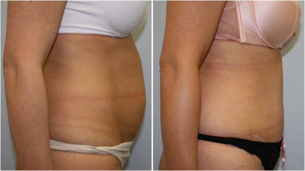 37yo female, 2 children, significant bulge from widely separated muscles eliminated with a tummy tuck procedure.